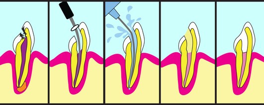 Endodoncia