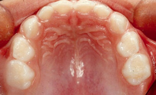 dentición